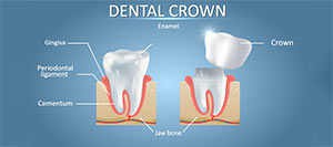 Dental Crown Specialist Near Me in Mesquite, Dallas, TX