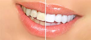 Teeth Whitening Treatment Near Me in Mesquite, TX