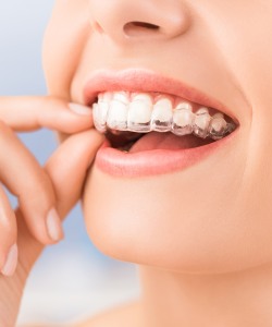 Clear Aligners Dentist Serving Mesquite Dallas, TX